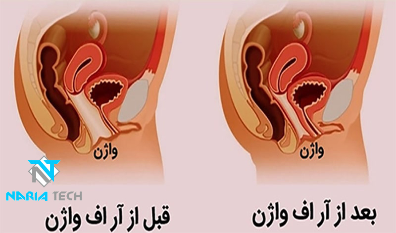 جوان سازی واژن با آر اف فرکشنال